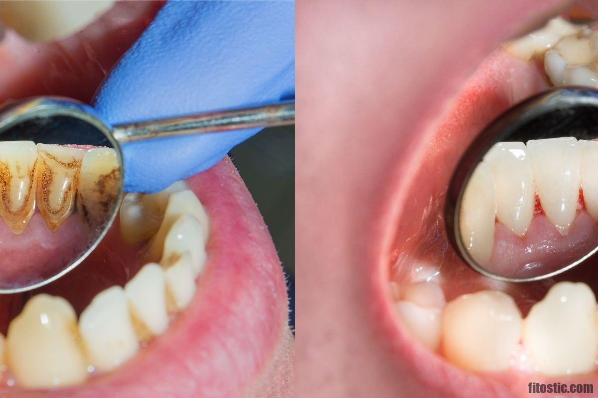 Quelles sont les complications de la carie dentaire ?