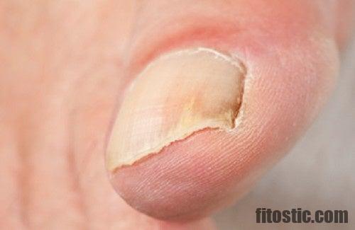 Quelles sont les maladies des ongles ?
