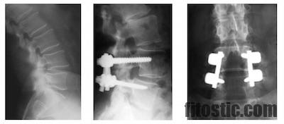 Quelles sont les suites d'une pneumonie ?