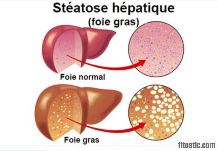 Quels sont les symptômes de la maladie du foie gras ?