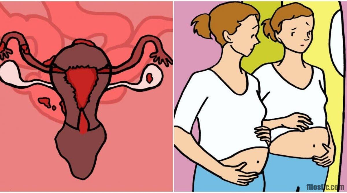 Quels sont les symptômes d'un kyste de l'ovaire ?