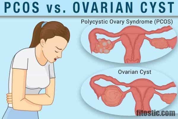 Quels sont les symptômes d'un kyste ovarien ?