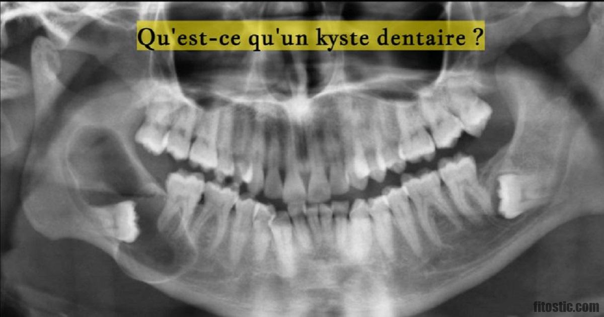 Qu'est-ce qui cause le kyste ?