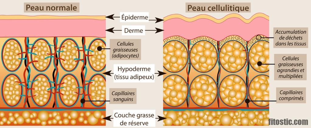 Qu'est-ce qui enlever la cellulite ?