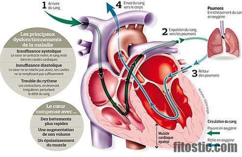 Qu'est-ce qui provoque une insuffisance cardiaque ?