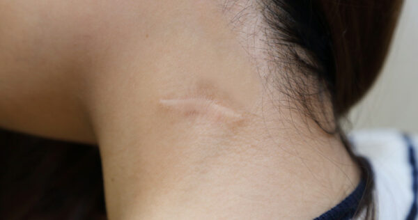 Qu'estce qu'une cicatrice Cheloide ? Sport, Mode