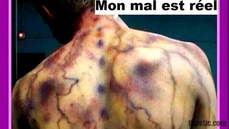 Qui déclare la fibromyalgie ?