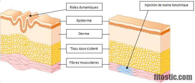 Qui fait les injections de toxine botulique ?