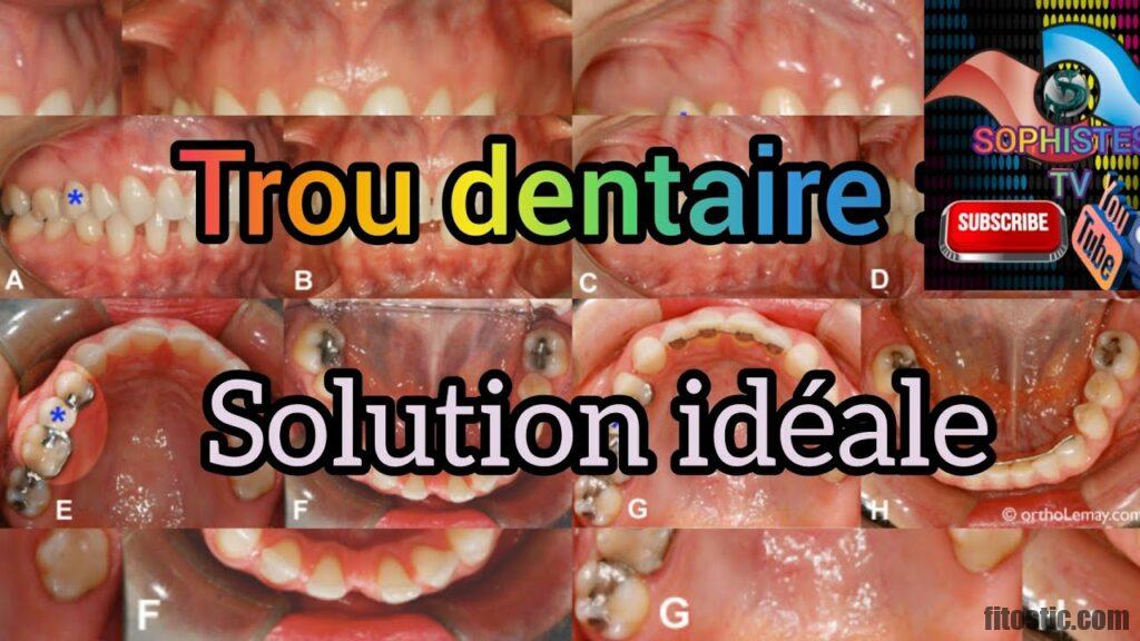 Comment Reboucher un Trou dans une Dent en Attendant le Dentiste