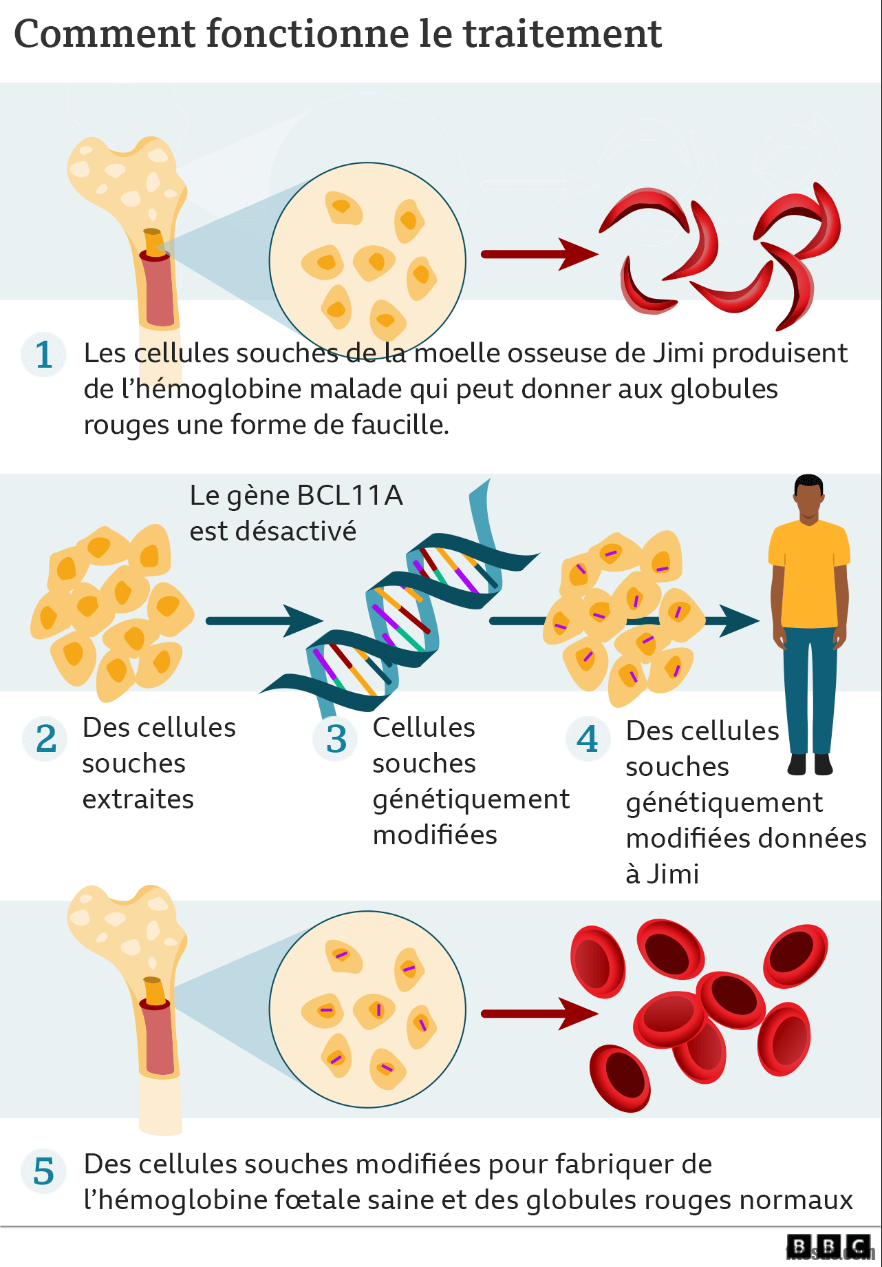 Comment vivre longtemps avec la drépanocytose ?