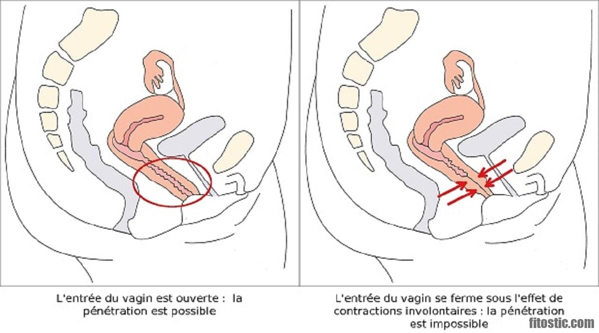 Comment savoir si on a un problème gynécologique ?