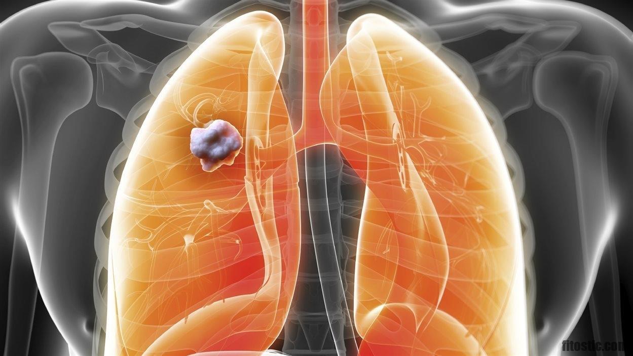 Comment se rendre compte que l'on a un cancer du poumon ?