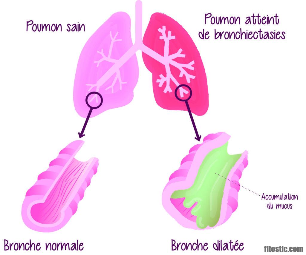 Comment réduire l'inflammation des poumons ?