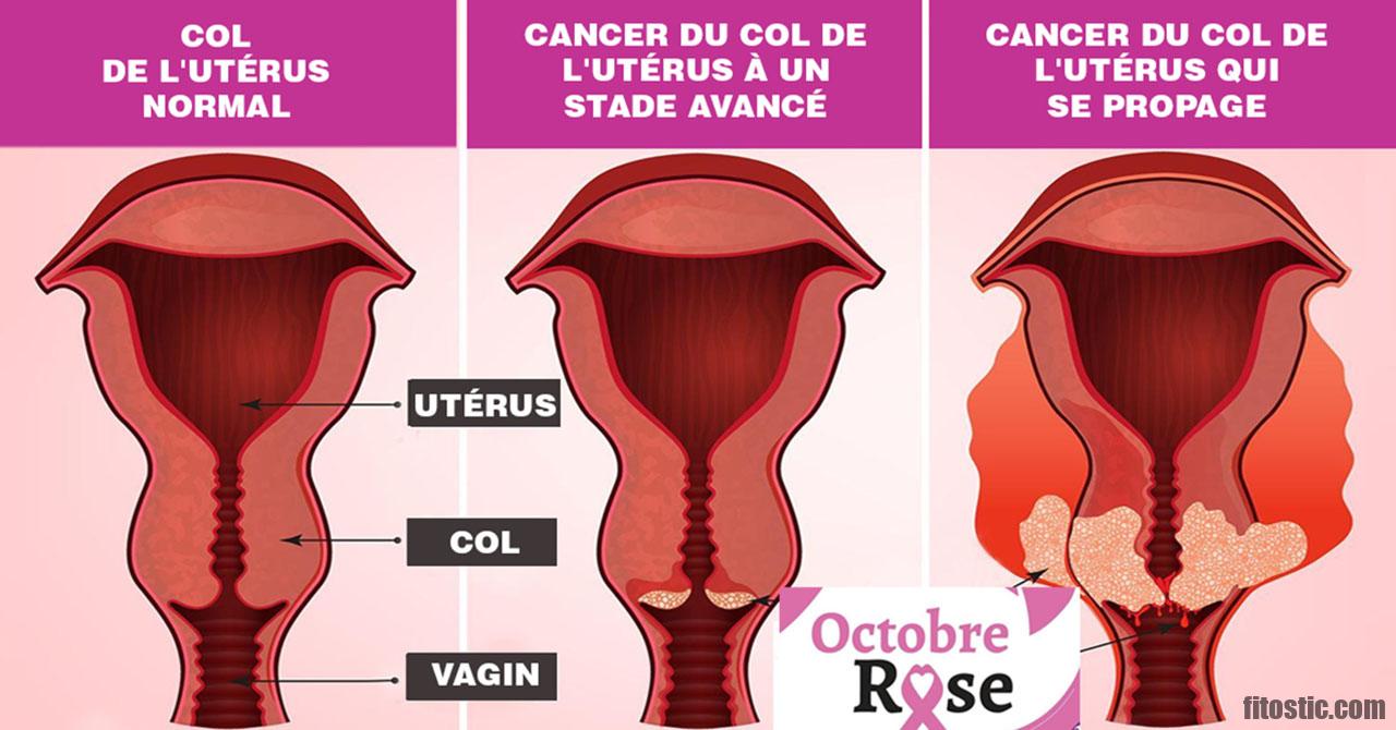 Comment savoir si mon utérus est malade ?