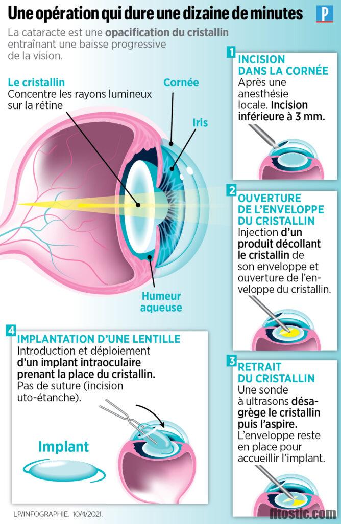 Pourquoi opérer les deux yeux de la cataracte