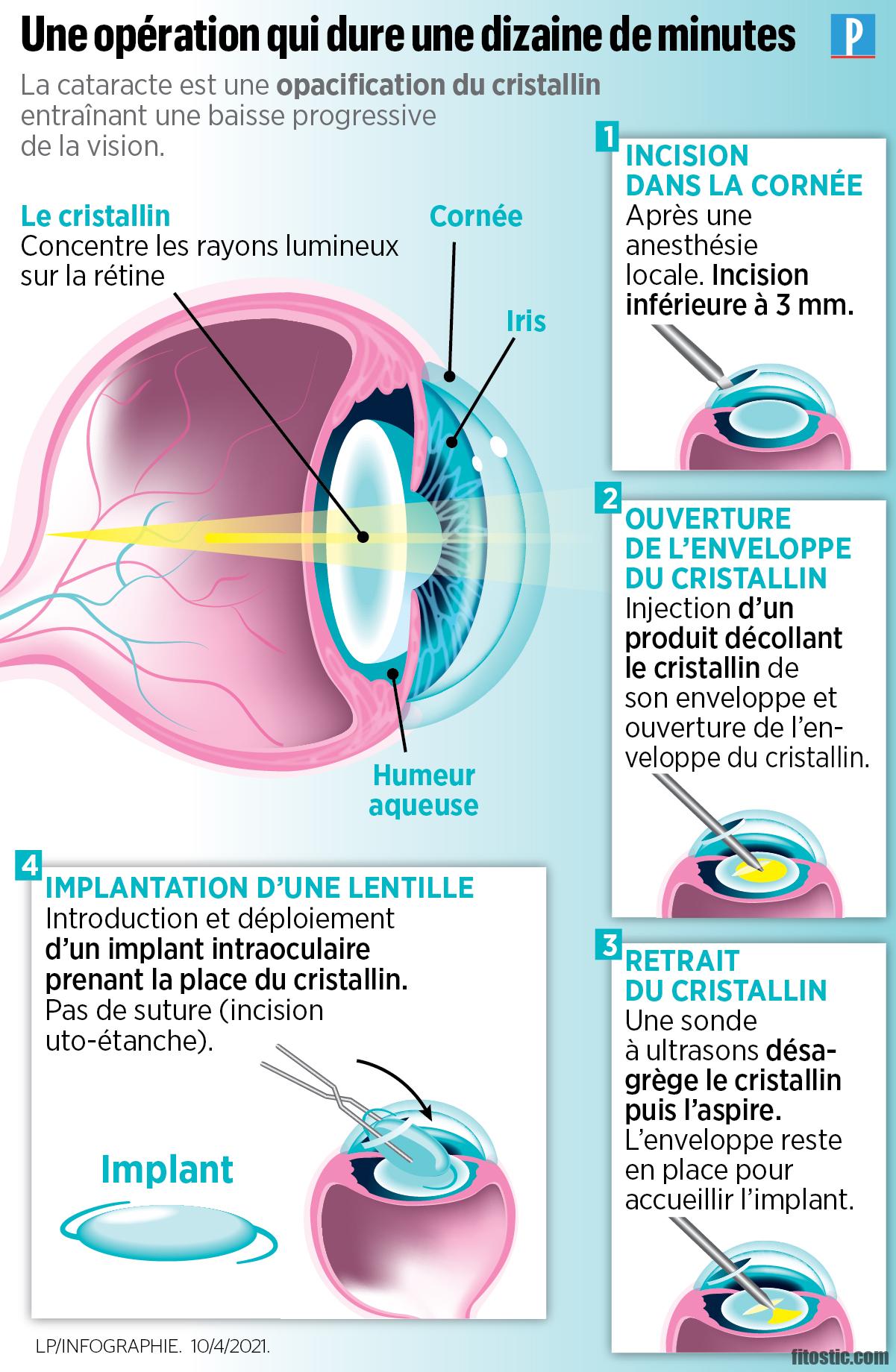 Pourquoi opérer les 2 yeux de la cataracte ?