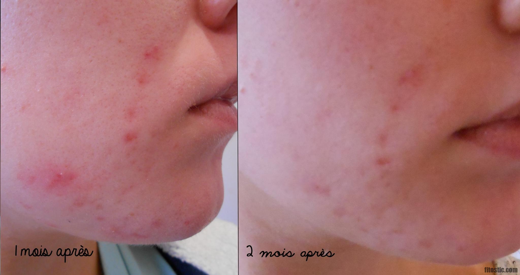 Quand disparaissent les effets secondaires roaccutane ?