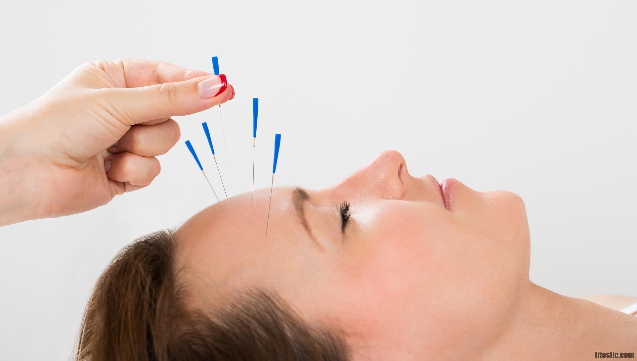 Quel est le prix d'une séance d'acupuncture ?