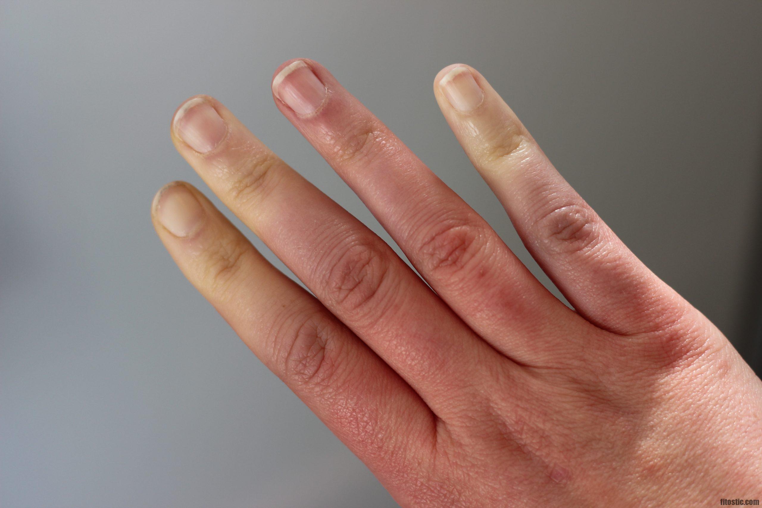 Quelle est la différence entre la maladie de raynaud et le syndrome de raynaud ?