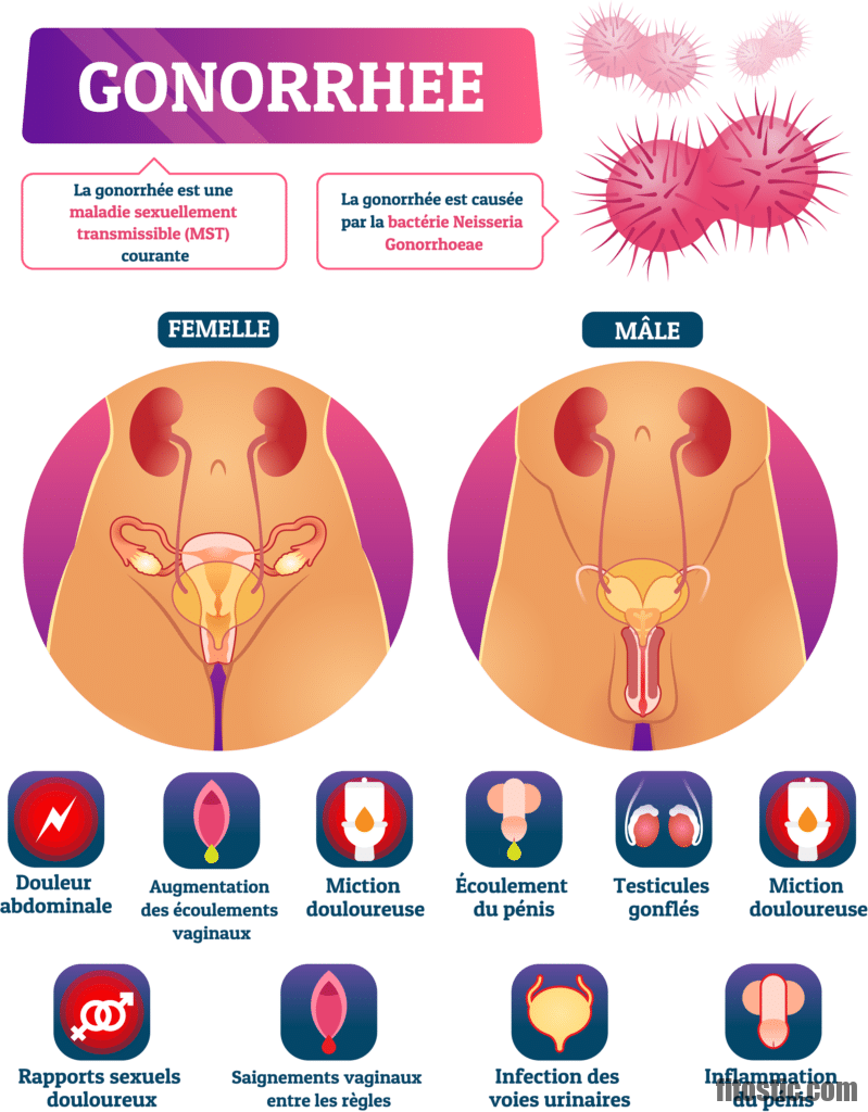 Quels sont les symptômes de la gonococcie chez l'homme ?