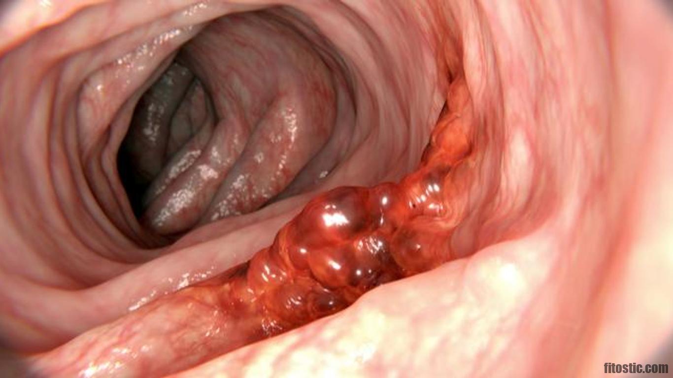 Comment sont les selles lors d'un cancer du colon ?